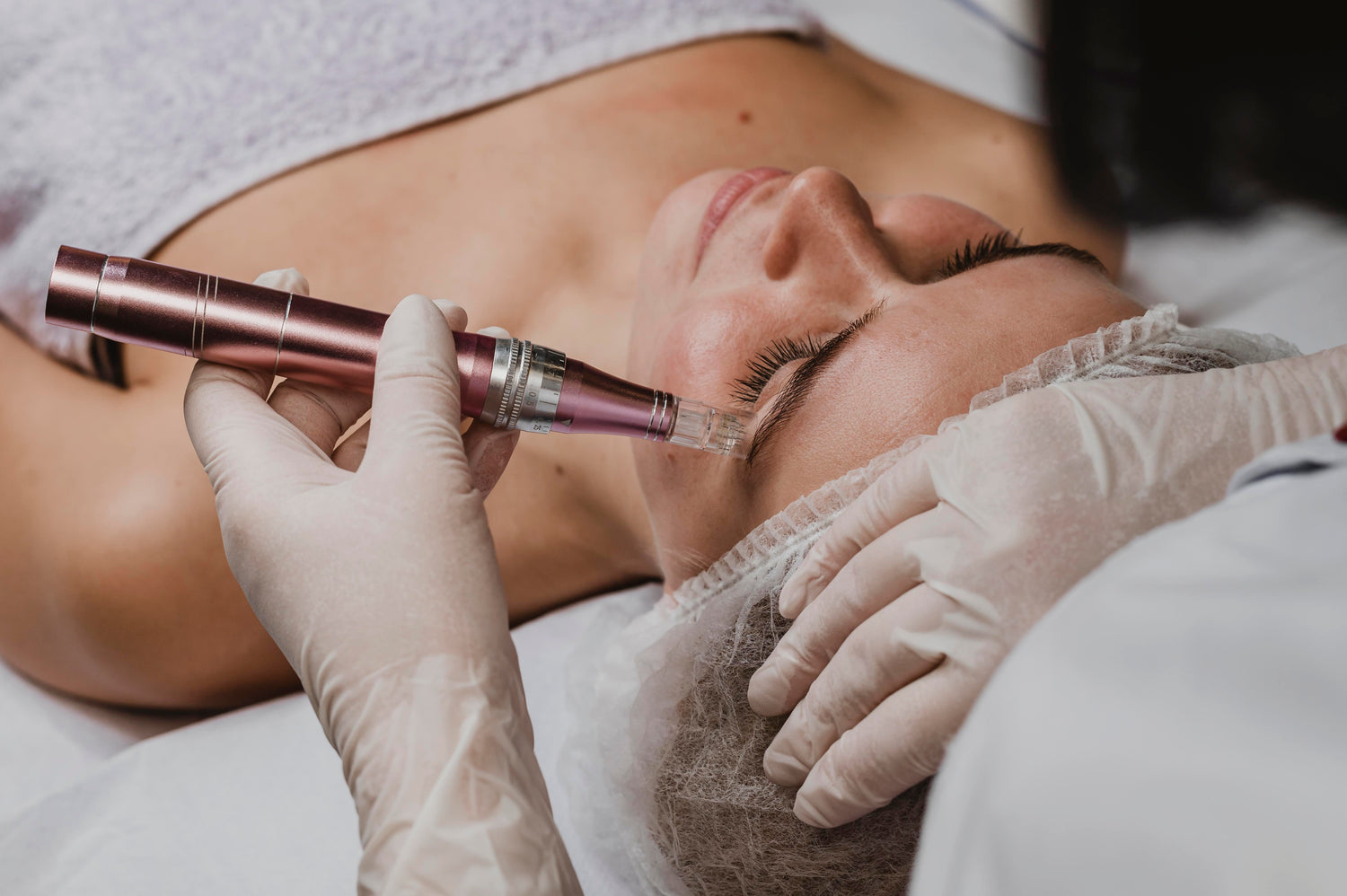 Microneedling Therapy